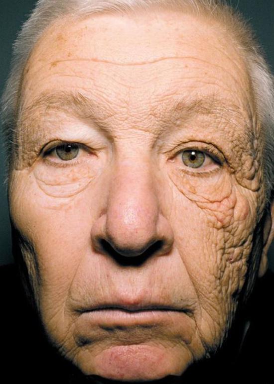 ▲根據(jù)《新英格蘭醫(yī)學雜志》報道，69歲的Bill McElligott 從事送貨工作已經(jīng)有28年了。紫外線透過車窗直接照射在他的左臉上，嚴重損壞了該側(cè)的皮膚，導致他左臉比右臉衰老更明顯。