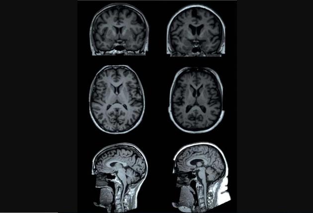 一項(xiàng)最新研究發(fā)現(xiàn)，體脂越高，大腦某些區(qū)域容量就越小。上圖為研究中兩名測試者(年齡均為65歲的女性)的大腦核磁共振掃描。一名測試者(左側(cè)圖)體脂為13%，另一名測試者(右側(cè)圖)體脂為49%。核磁共振掃描顯示，與左圖測試者相比，右圖測試者大腦某些區(qū)域(“皮質(zhì)下區(qū)域”)灰質(zhì)容量較低。